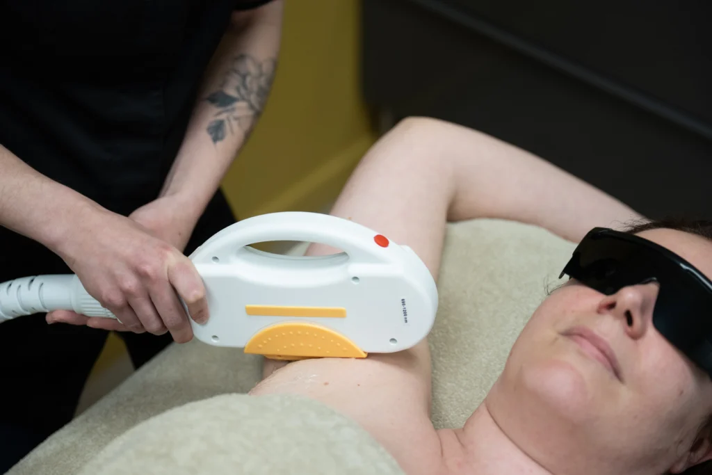 lumière pulsée laser épilation définitive Agen