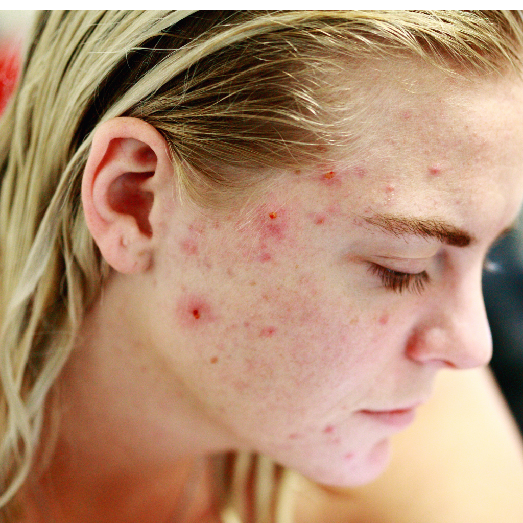 Acné Agen dermatologue institut beauté